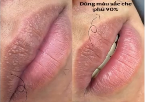 Điều Trị Laser  Hạt  Bã Nhờn