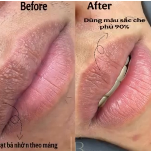 Điều Trị Laser  Hạt  Bã Nhờn