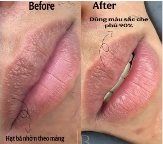 Điều Trị Laser  Hạt  Bã Nhờn