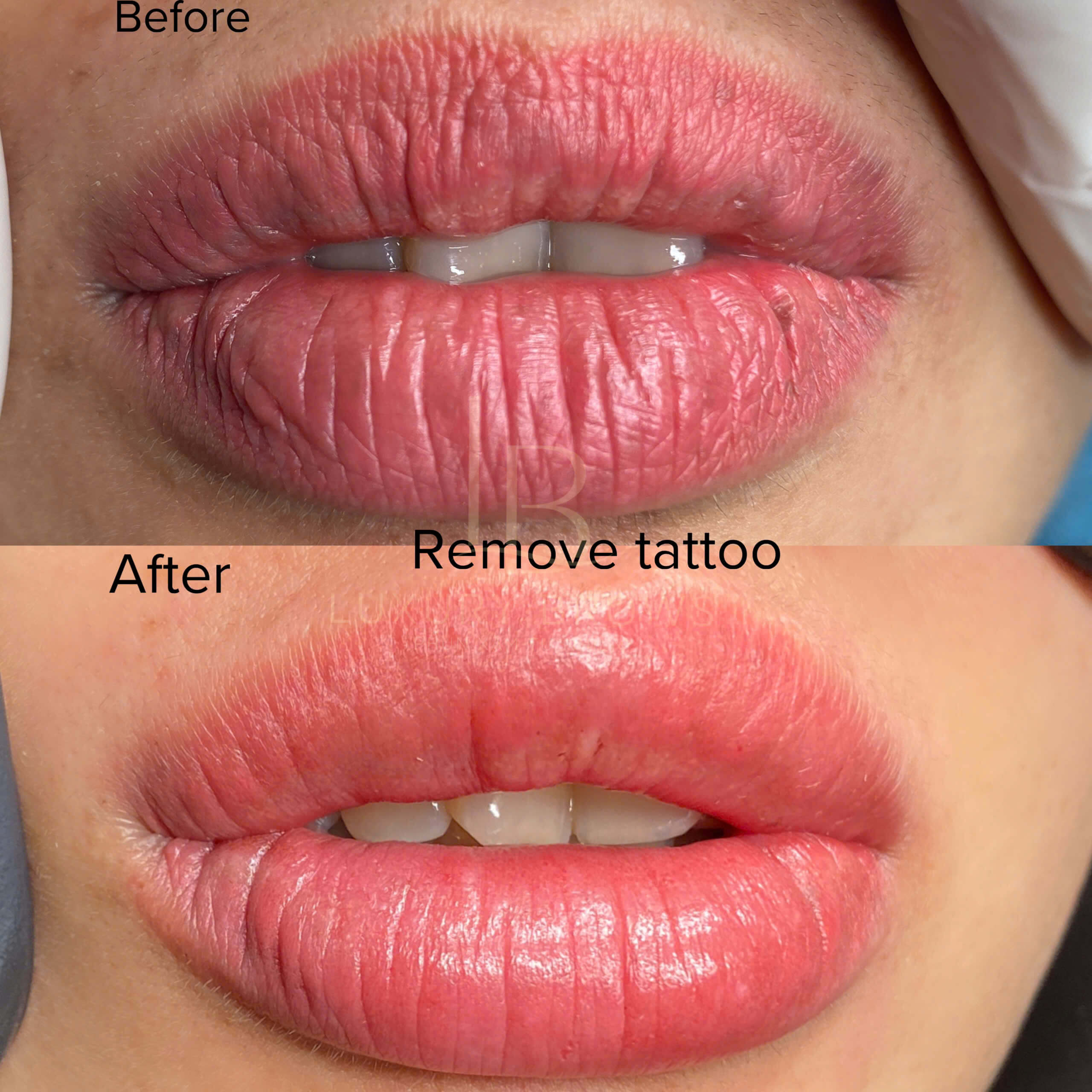 Hút dung dịch môi